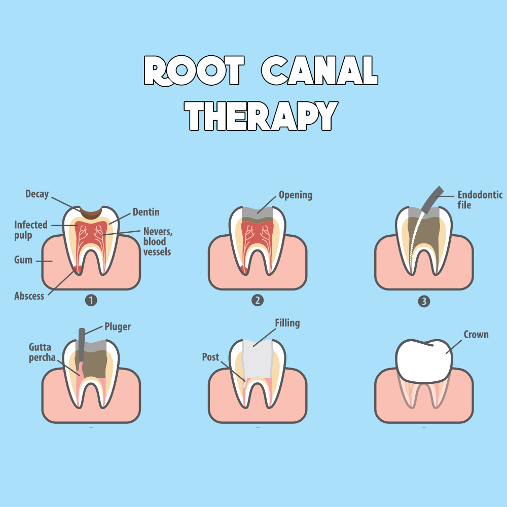 root-canal-treatment-mt-brydges-family-dental