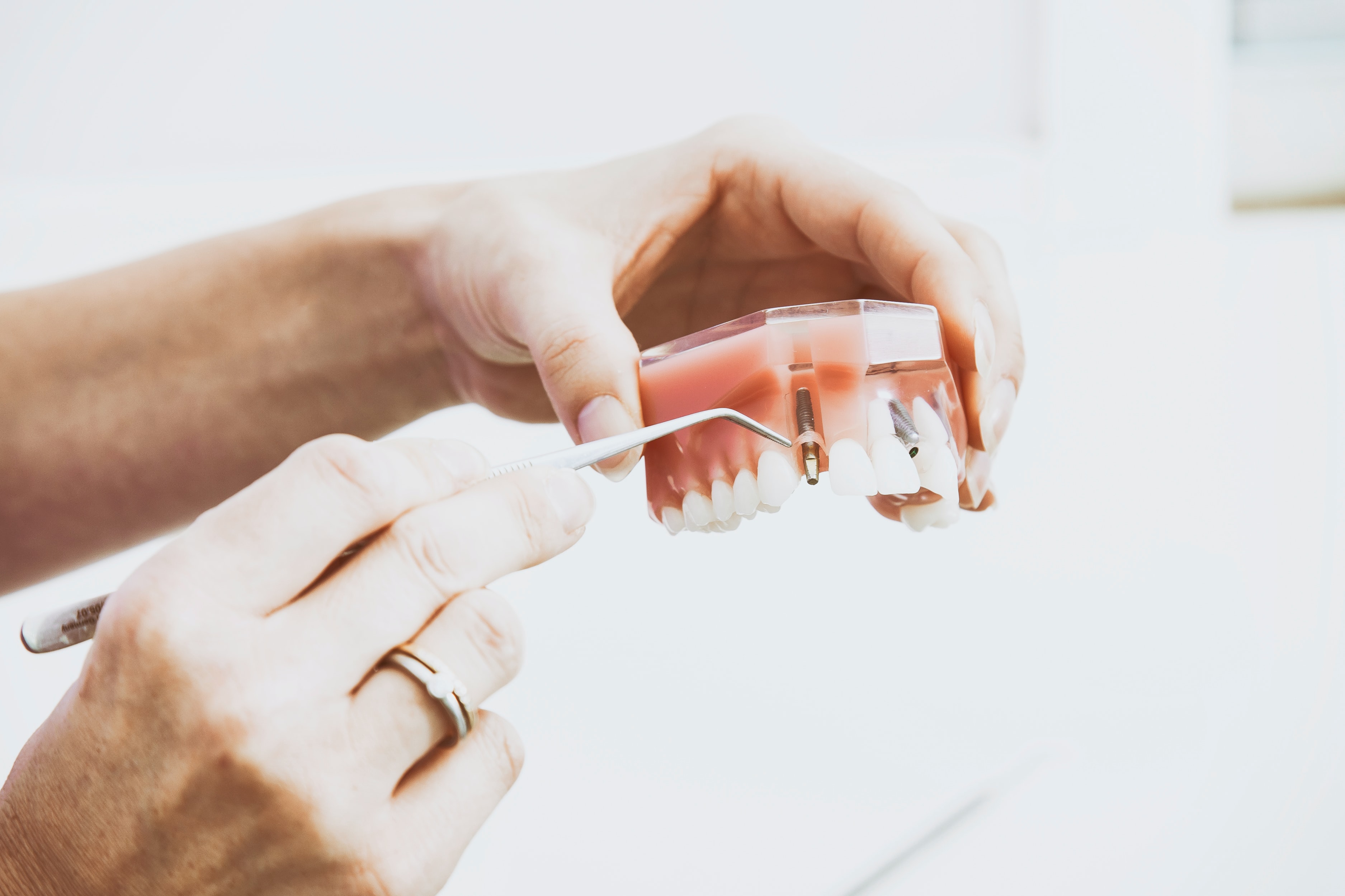 A photo of a set of dental implants.