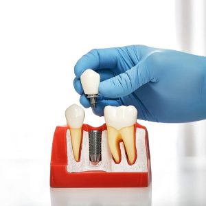 Implant Dentistry in Mt. Brydges, ON