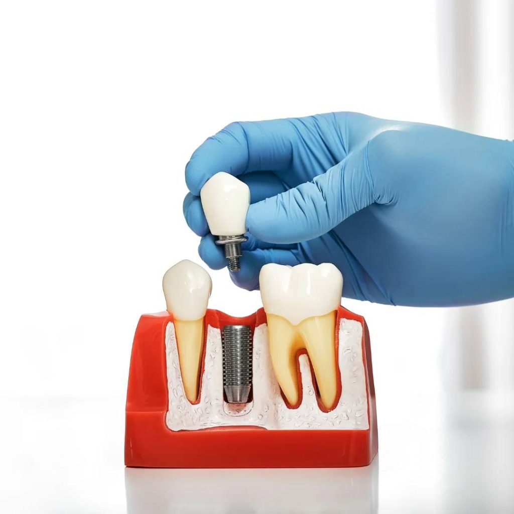 Implant Dentistry Mt. Brydges, ON